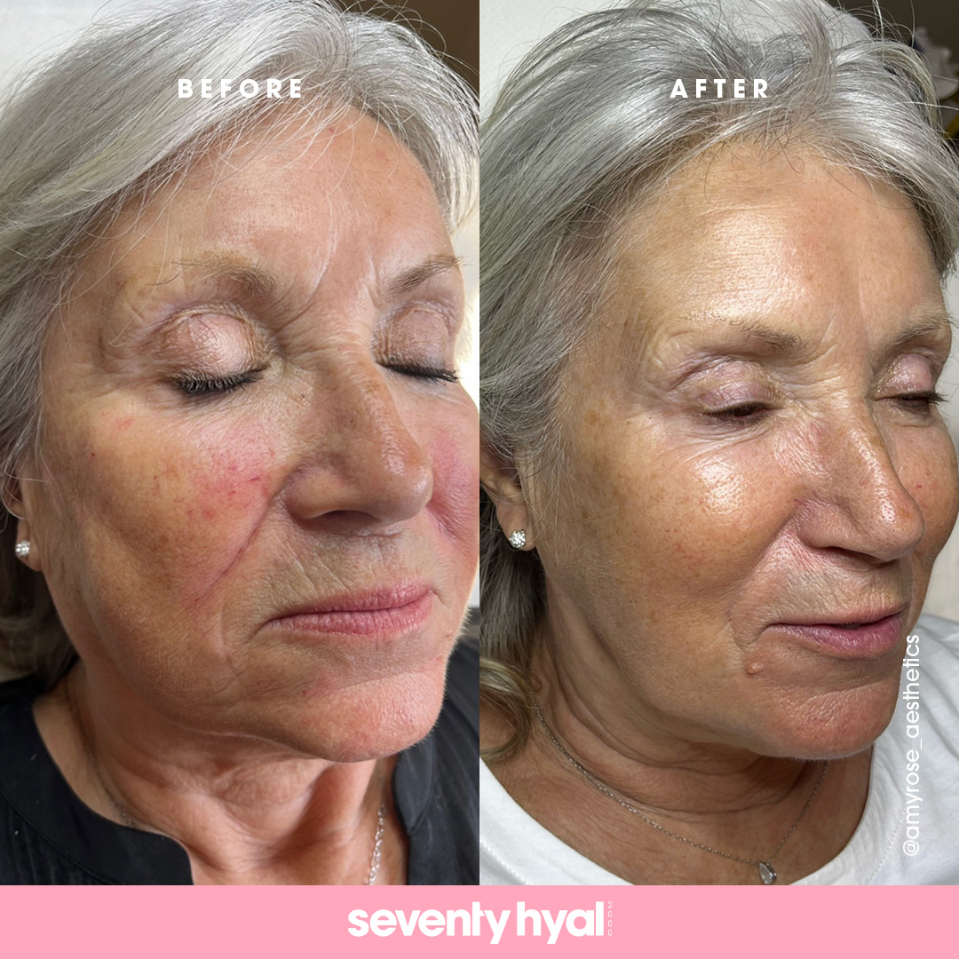 Seventy Hyal skin booster before and after results