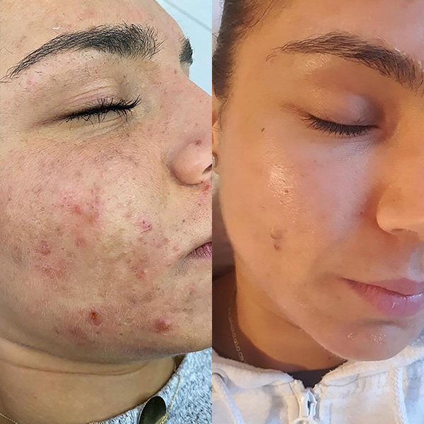 Before and after algae peel - acne and congestion improvement