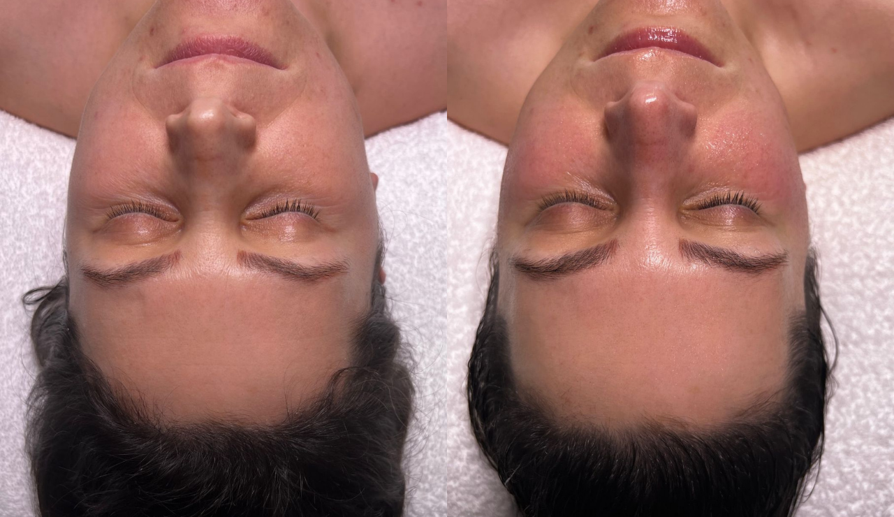 Skin Serenity Bespoke Facial before and after