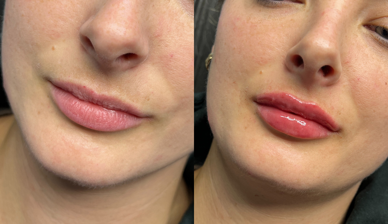 Improved Lip Symmetry
