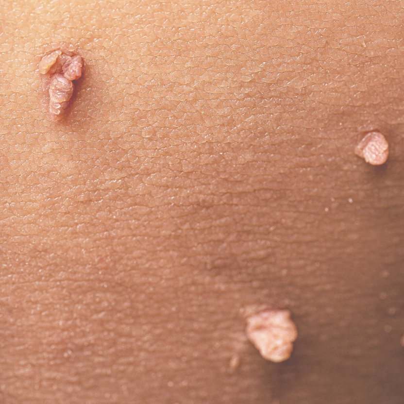 Skin tags close up