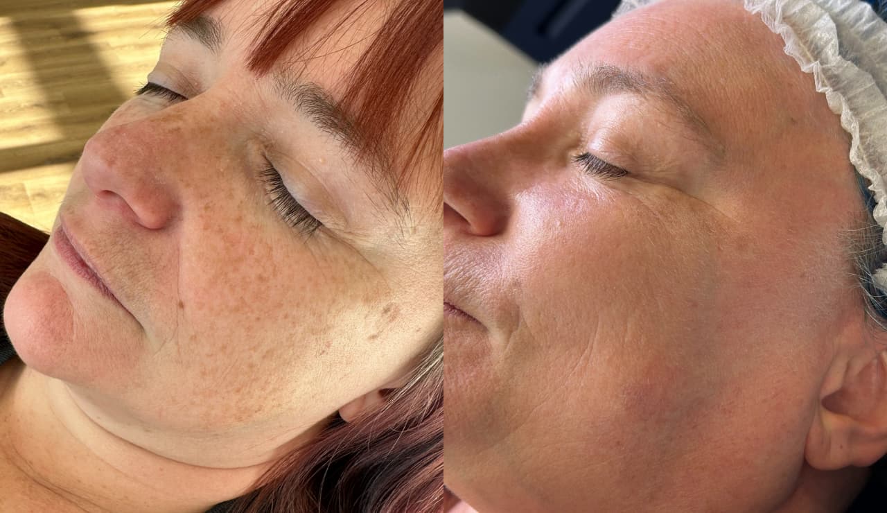 Before and after laser pigmentation removal
